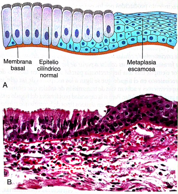 metaplasia