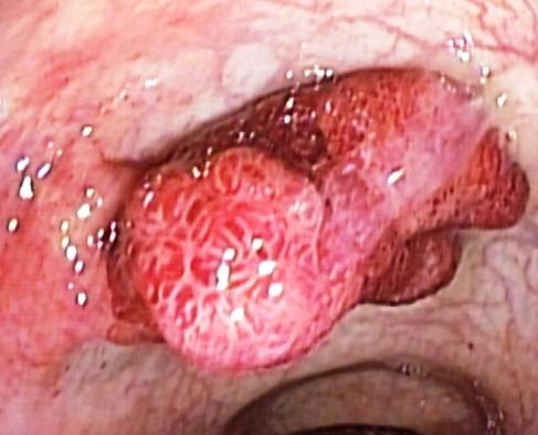 Pólipo con displasia de alto grado cancer de colon in sito