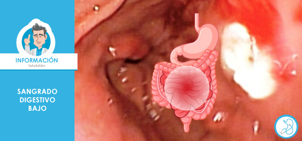 Sangrado digestivo bajo Serviendoscopias Gastroenterólogo Bogotá