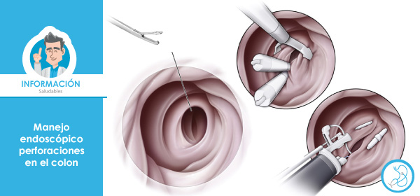 Manejo endoscopio perforaciones en el colon Gastroenterólogo Bogotá